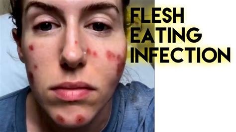 Flesh Eating Disease Face