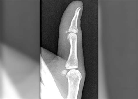 Avulsion fracture | Injuries, Fractures and Burns articles | Body ...