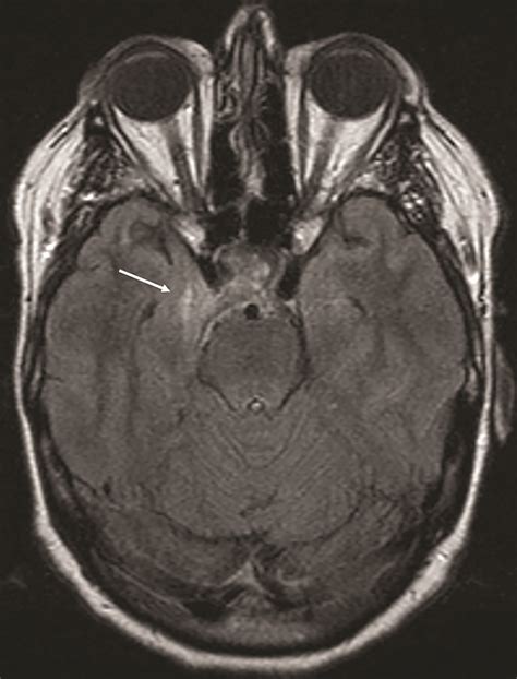 Dural Arteriovenous Fistula • APPLIED RADIOLOGY