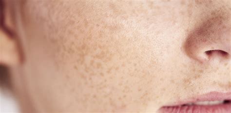 Hyperpigmentation Treatments | Ventura County | Bloom Med Spa