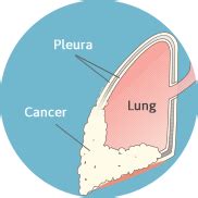 Pleural Mesothelioma: A Guide to Understanding Pleural Cancer