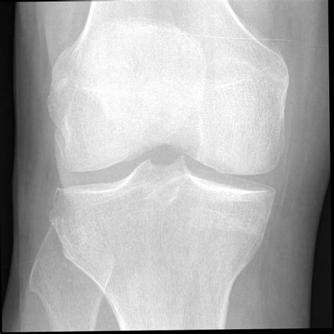 Radiographs of a patient with knee OA progressed in 8 years. The red ...