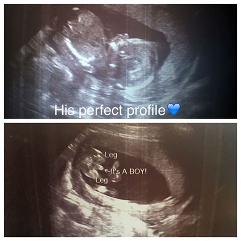 16 week ultra sound gender reveal | Medical ultrasound, 16 weeks pregnant ultrasound, Baby scan