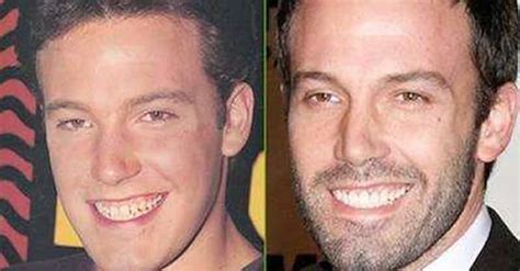 Celebrities with Fake Teeth | List of Famous People with Dentures and Dental Implants