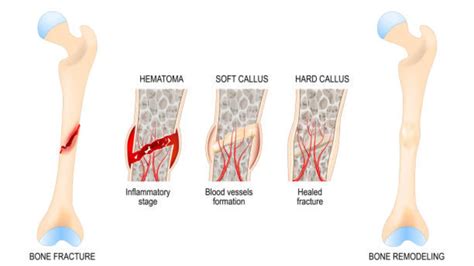 Trabecular Fracture: Causes & Best Treatment - Health 24