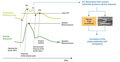 Interpretation of intracranial pressure curves :: Christoph Miethke ...