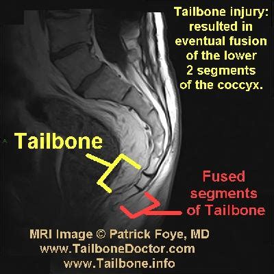 Tailbone Images (for coccyx pain) | Tailbone Doctor