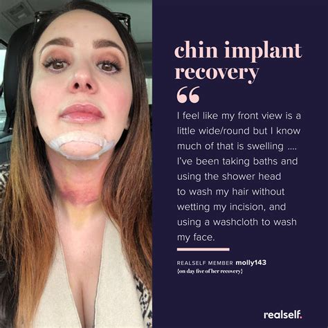 What is the estimated recovery time for a chin implant? | Chin implant, Implants, Chin