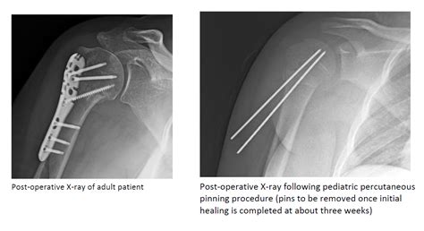 Proximal Humerus Fracture - Steven Chudik MD