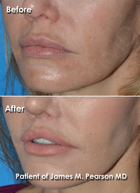 Lip Lift Photos - Before & After - Dr. James Pearson Facial Plastic Surgery