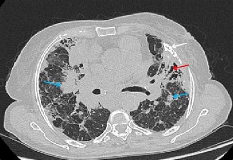 Traction bronchiectasis in a 69-year-old man. Axial CT scan shows... | Download Scientific Diagram