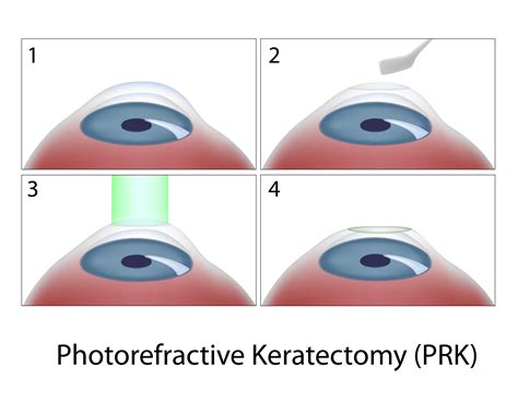 PRK Recovery - Chicago, IL - What to Expect during PRK Recovery