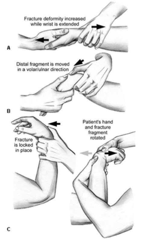 Wrist and Distal Forearm Injuries: Pearls & Pitfalls - emdocs