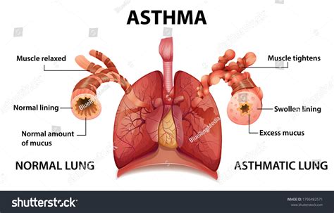 1,266 Asthma Diagram Images, Stock Photos, 3D objects, & Vectors | Shutterstock