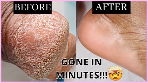 HOW TO REMOVE DEAD SKIN CELLS FROM YOUR FEET IN MINUTES | Self Care Routine - YouTube