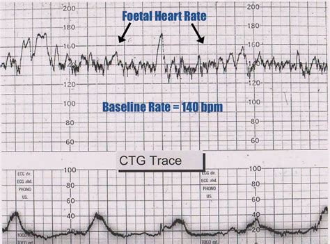 How to read a CTG | Geeky Medics | Nursing school survival, Medical ...