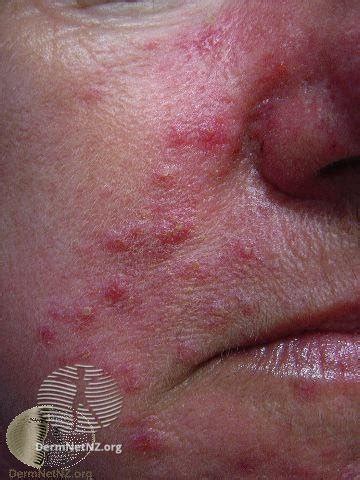 Understanding Rosacea - theGoodSkinPlace