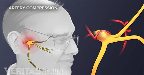 Trigeminal Neuralgia Causes and Risk Factors