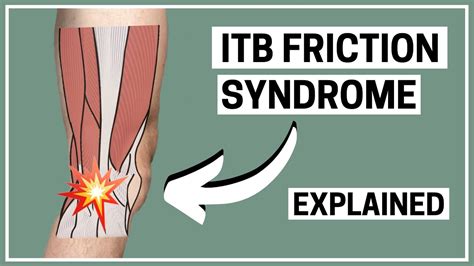 Runners Knee - ITB friction syndrome diagnosis and treatment explained - YouTube