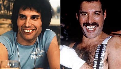 why were freddie mercury's teeth like that | ILAJAK Medical