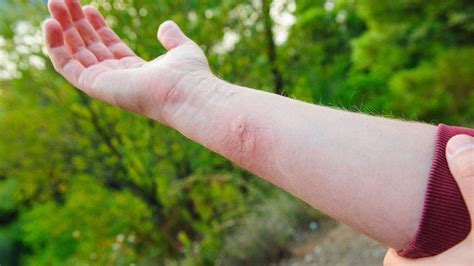 Identify & Treat Insect Bites & Stings | Australia Wide First Aid