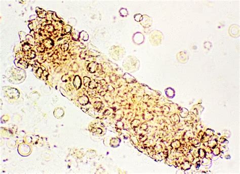 Rbc Cast In Urine