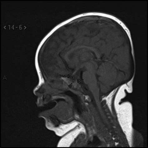 T1-weighted sagittal MRI through the pituitary fossa shows a thin ...