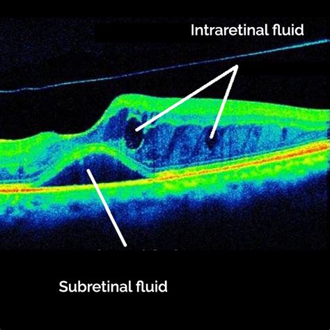 Diabetic Retinopathy Hannibal | International Eyecare Center - Hannibal