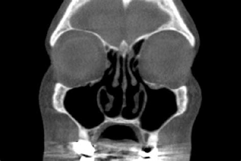 Sinus CT scan Ã following suctioning of both maxillary sinuses. | Download Scientific Diagram