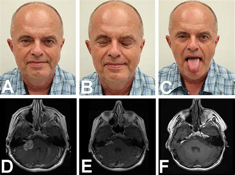 Acoustic neuroma facial – Telegraph