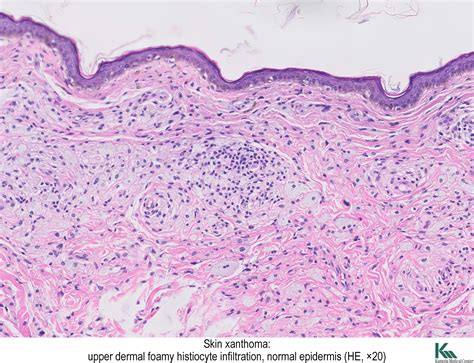 Xanthelasma Histology