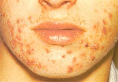 The Truth about Acne Papules and Pustules | Home remedies for acne, Pustules acne, Papules acne