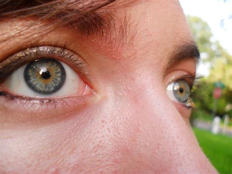 Central heterochromia? | Augen