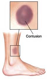 Contusion Types, Symptoms and Treatments | New Health Advisor