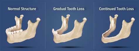 Tooth Loss | Jaw Bone Loss | Dental Health