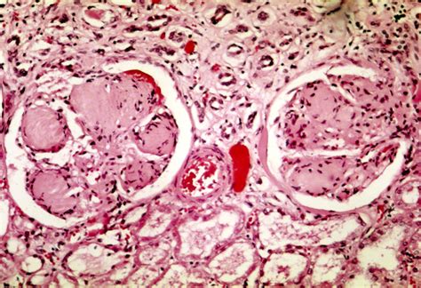 Public Domain Picture | Histopathology of the kidney revealing nodular glomerulosclerosis ...