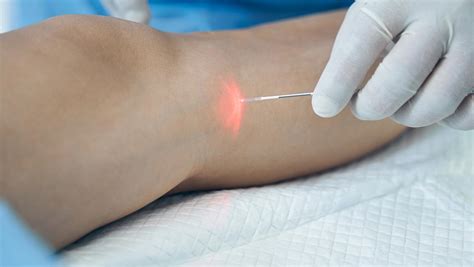 Understanding Endovenous Laser Ablation (EVLA): Procedure and Recovery - Sonoran Vein and ...