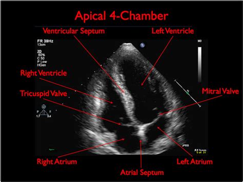 Apical Four Chamber View – Toronto Notes