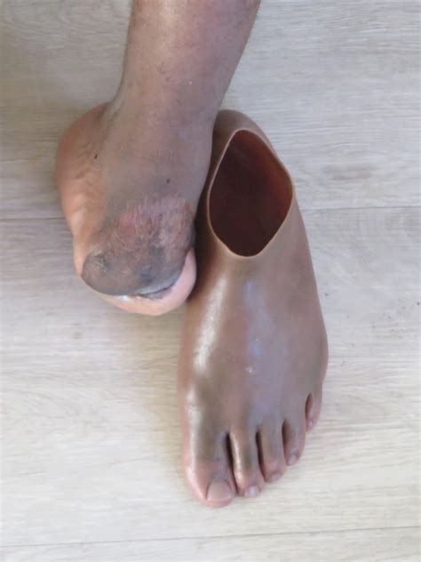 Silicone Partial Feet - Eugene Rossouw Prosthetics