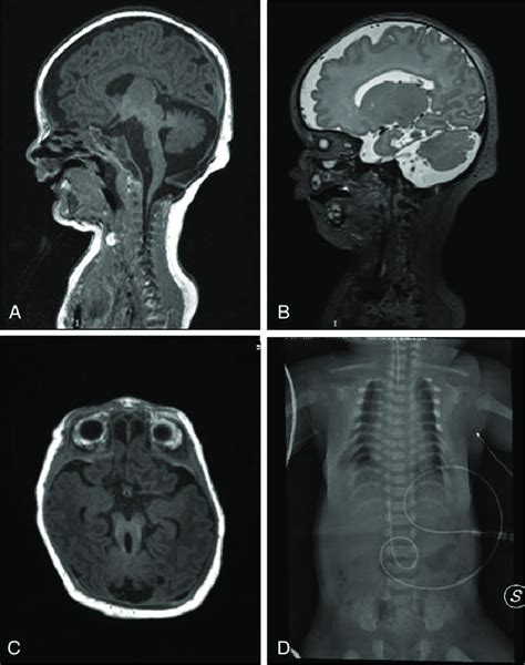 Patient 2 (A-C) Brain MRI showing cortical thickening with simplified... | Download Scientific ...