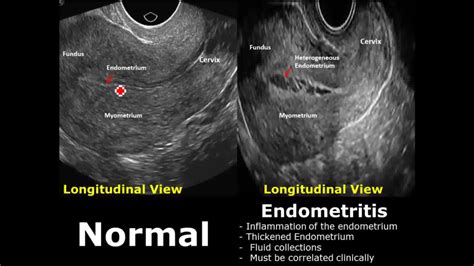 Routine Expert-guided Transvaginal Ultrasound In The, 55% OFF