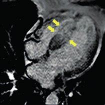 A: transthoracic echocardiography. Interventricular septum with a 32 mm... | Download Scientific ...