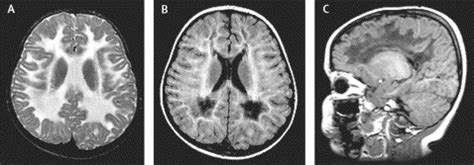 Vanishing white matter disease - The Lancet Neurology