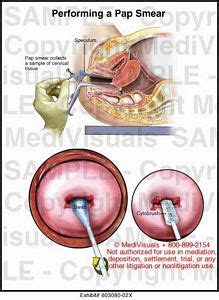 Medivisuals Performing a Pap Smear Medical Illustration