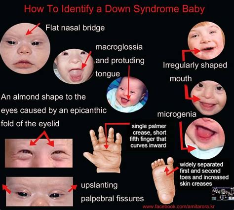 Upslanting Palpebral Fissure