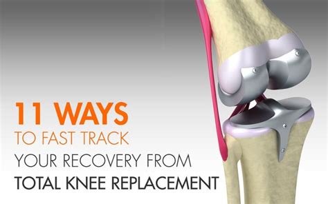 11 Effective Ways to Speed Up Your Recovery from Total Knee Replacement