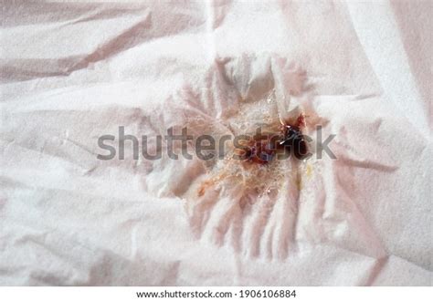 596 Blood In Sputum Images, Stock Photos & Vectors | Shutterstock