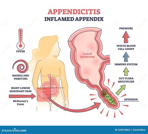 Appendicitis, Inflamed Appendix, Abdominal Problem Diagnosis Outline ...