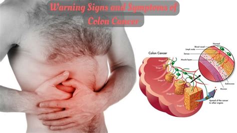 Warning Signs and Symptoms of Colon Cancer