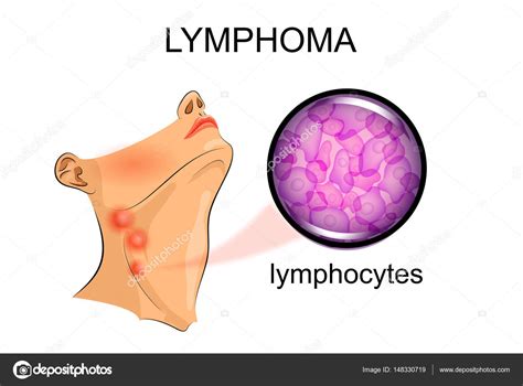 Swollen lymph nodes in lymphoma. Oncology Stock Vector Image by ©Artemida-psy #148330719